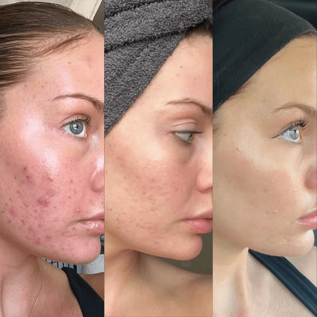 10% Vitamin C   Squalane Repair Cream - Hyperpigmentation, Acne, Wrinkles