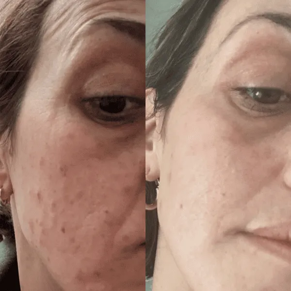 10% Vitamin C   Squalane Repair Cream - Hyperpigmentation, Acne, Wrinkles